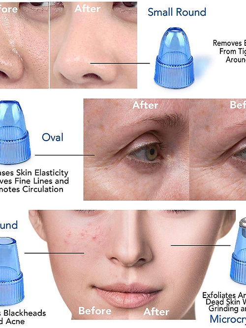 Derma Suction Facial Pore Cleanser - Blackhead Whitehead Remover Suction Machine - Link Lift Shop