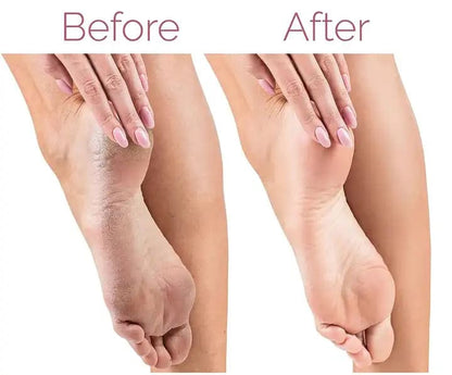 Rechargeable Flawless Electric Foot Callus and dead body Remover